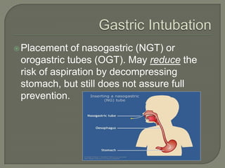  Placement   of nasogastric (NGT) or
 orogastric tubes (OGT). May reduce the
 risk of aspiration by decompressing
 stomach, but still does not assure full
 prevention.
 