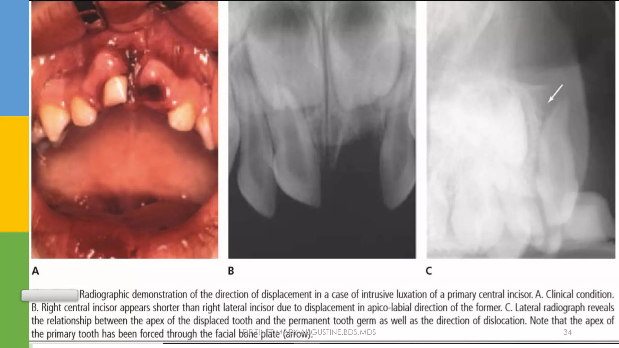 Traumatic injury to the primary dentition | PDF