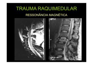 TRAUMA RAQUIMEDULAR
RESSONÂNCIA MAGNÉTICA

 