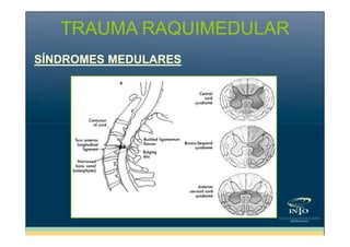TRAUMA RAQUIMEDULAR
SÍNDROMES MEDULARES

 