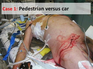 Case 1: Pedestrian versus car
 