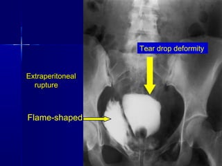 GenitoUrinary Trauma | PPT