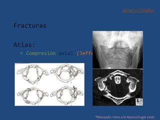generalidades
Fracturas
Atlas:
• Compresión axial (Jefferson)
*Mezzadri. Intro a la Neurocirugía 2006
 