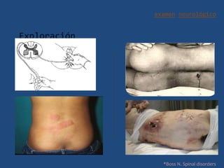 examen neurológico
Exploración
• Inspección
• Palpación
• Tacto rectal
*Boss N. Spinal disorders
 