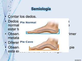 • Contar los dedos.
• Dedos, rectos, planos y en proporción
normal (un dedo no proporcional pude
estar tumefacto).
• Observar el arco longitudinal (entre primer
metatarsiano y el calcáneo).
• Diferenciar entre pie plano y cavo.
• Observar si el segmento posterior del pie
esta excesivamente varo o valgo.
Semiología
 