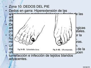 • Zona 10: DEDOS DEL PIE
• Dedos en garra: Hiperextensión de las
articulaciones metatarsofalángica y flexión de las
articulaciones interfalangicas proximales y
distales.
• Dedos en martillo: Hiperextensión de las
articulaciones metatarsofalángica e interfalangicas
proximales y flexión de las interfalangicas distales.
• Callosidades: Entre los dedos son suaves por la
humedad de los dedos, a menudo dolorosas,
mientras que en las zonas de presión son duras.
• Uñas encarnadas: Se producen en la porción
medial o lateral del dedo gordo, las esquinas de la
uña se enclava en la piel circundante y producen
tumefacción e infección de tejidos blandos
adyacentes.
 