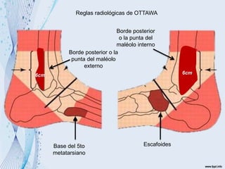 6cm 6cm
Reglas radiológicas de OTTAWA
Borde posterior o la
punta del maléolo
externo
Borde posterior
o la punta del
maléolo interno
Base del 5to
metatarsiano
Escafoides
 