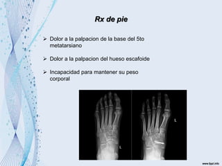 Rx de pie
 Dolor a la palpacion de la base del 5to
metatarsiano
 Dolor a la palpacion del hueso escafoide
 Incapacidad para mantener su peso
corporal
 