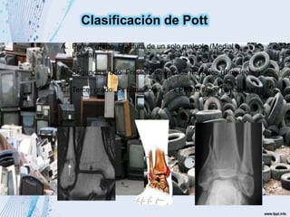 A. Primer grado: Fractura de un solo maleolo (Medial o
Lateral)
B. Segundo grado: Fractura de los dos maleolos (Bimaleolar)
C. Tercer grado: Fx bimaleolar + Fx PPSAI tibia (Trimaleolar)
Clasificación de Pott
 