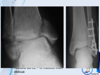 Ruptura del ligamento lateral
externo
Avulsión del maléolo externo
Ruptura del LL + fx maléolo inter,
oblicua
Supinación – Aducción
 
