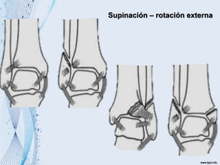 Supinación – rotación externa
 