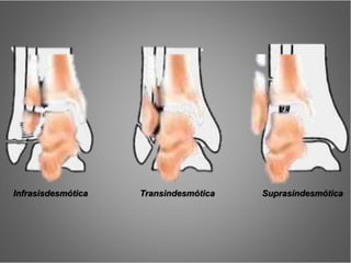 Transindesmótica SuprasindesmóticaInfrasisdesmótica
 