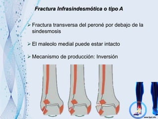 Fractura Infrasindesmótica o tipo A
Fractura transversa del peroné por debajo de la
sindesmosis
El maleolo medial puede estar intacto
Mecanismo de producción: Inversión
 