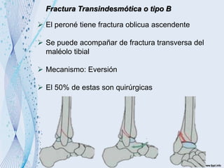 Fractura Transindesmótica o tipo B
 El peroné tiene fractura oblicua ascendente
 Se puede acompañar de fractura transversa del
maléolo tibial
 Mecanismo: Eversión
 El 50% de estas son quirúrgicas
 