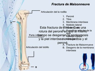 Fractura de Maisonneuve
1. Peroné
2. Tibia
3. Membrana interósea
4. Maléolo lateral
5. Sindesmosis
6. Superficie articular de la
tibia
7. Maléolo medial
8. Astrágalo
A. Fractura de Maisonnueve
B. Desgarro de la membrana
interósea
Articulación del la rodilla
Parte interna
Articulación del tobillo
Esta fractura de Weber C es una
rotura del peroné en que al mismo
tiempo se desgarran la sindesmosis
y la piel interósea entre la tibia y el
peroné.
A
B
 