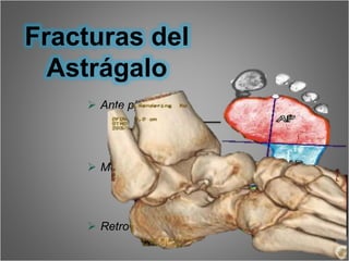 Fractura de Pie
 Ante pie
 Medio pie
 Retro pie
Fracturas del
Astrágalo
 