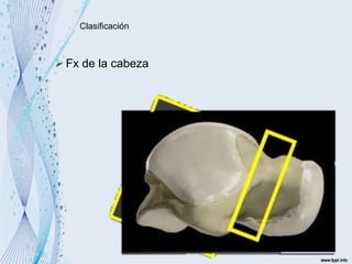 Clasificación
Fx de la cabeza
 