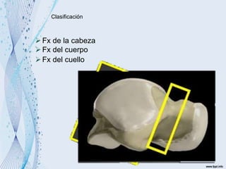 Clasificación
Fx de la cabeza
Fx del cuerpo
Fx del cuello
 