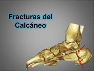 Fracturas del
Calcáneo
 