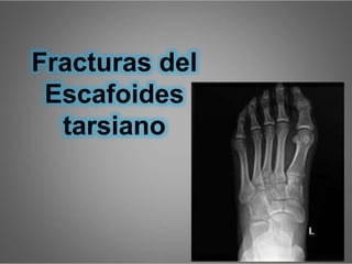 Caída de altura con compromisos de los
talones
Apariencia clínica
Ancho
Corto y aplanado
Con ligera desviación
Signo de inflamación
Equimosis notable en el
talón
Fracturas del
Escafoides
tarsiano
 