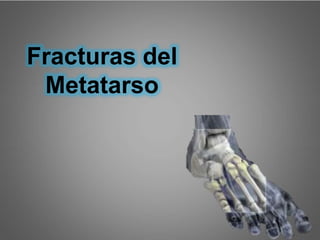 Miren fijo la siguiente
imagen.!
Se les parece
a alguien.?
Fracturas del
Metatarso
 