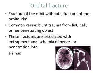 Orbital fracture
• Fracture of the orbit without a fracture of the
orbital rim
• Common cause: blunt trauma from fist, ball,
or nonpenetrating object
• These fractures are associated with
entrapment and ischemia of nerves or
penetration into
a sinus
 