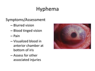 Hyphema
Symptoms/Assessment
– Blurred vision
– Blood tinged vision
– Pain
– Visualized blood in
anterior chamber at
bottom of iris
– Assess for other
associated injuries
 