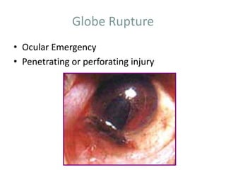 Globe Rupture
• Ocular Emergency
• Penetrating or perforating injury
 