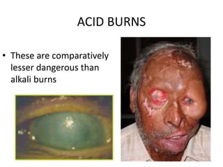 ACID BURNS
• These are comparatively
lesser dangerous than
alkali burns
 