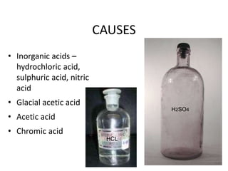 CAUSES
• Inorganic acids –
hydrochloric acid,
sulphuric acid, nitric
acid
• Glacial acetic acid
• Acetic acid
• Chromic acid
H2SO4
HCL
 