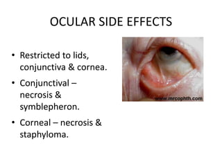 OCULAR SIDE EFFECTS
• Restricted to lids,
conjunctiva & cornea.
• Conjunctival –
necrosis &
symblepheron.
• Corneal – necrosis &
staphyloma.
 