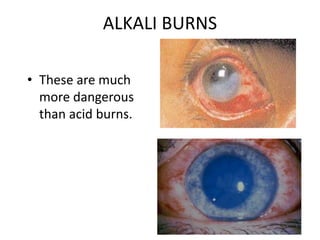 ALKALI BURNS
• These are much
more dangerous
than acid burns.
 