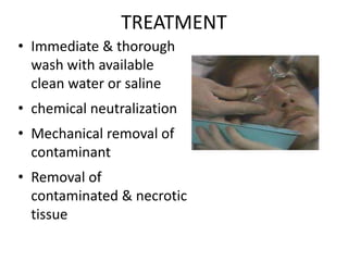 TREATMENT
• Immediate & thorough
wash with available
clean water or saline
• chemical neutralization
• Mechanical removal of
contaminant
• Removal of
contaminated & necrotic
tissue
 