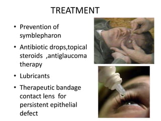 TREATMENT
• Prevention of
symblepharon
• Antibiotic drops,topical
steroids ,antiglaucoma
therapy
• Lubricants
• Therapeutic bandage
contact lens for
persistent epithelial
defect
 