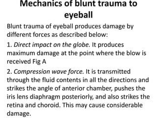 Mechanics of blunt trauma to
eyeball
Blunt trauma of eyeball produces damage by
different forces as described below:
1. Direct impact on the globe. It produces
maximum damage at the point where the blow is
received Fig A
2. Compression wave force. It is transmitted
through the fluid contents in all the directions and
strikes the angle of anterior chamber, pushes the
iris lens diaphragm posteriorly, and also strikes the
retina and choroid. This may cause considerable
damage.
 