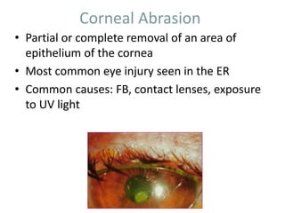 Corneal Abrasion
• Partial or complete removal of an area of
epithelium of the cornea
• Most common eye injury seen in the ER
• Common causes: FB, contact lenses, exposure
to UV light
 