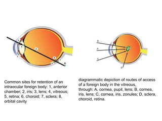 Common sites for retention of an
intraocular foreign body: 1, anterior
chamber; 2, iris; 3, lens; 4, vitreous;
5, retina; 6, choroid; 7, sclera; 8,
orbital cavity
diagrammatic depiction of routes of access
of a foreign body in the vitreous,
through: A, cornea, pupil, lens; B, cornea,
iris, lens; C, cornea, iris, zonules; D, sclera,
choroid, retina.
 