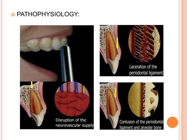 Traumatic injuries in pediatric dentistry | PPTX
