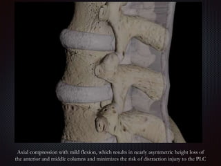 Imaging of thoracic spine Trauma | PPTX