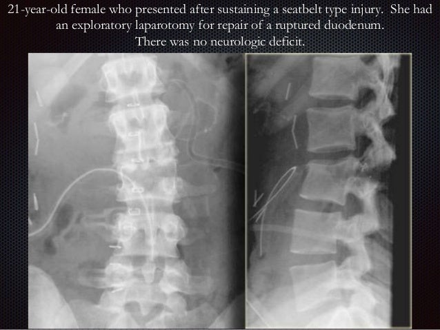 Imaging Of Thoracic Spine Trauma Imaging Of Thoracic Spine Trauma
