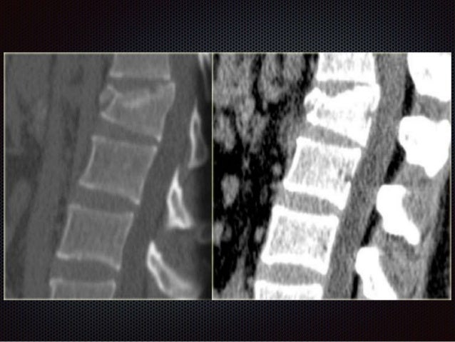 Компрессионный перелом тела 1 1. Компрессионный оскольчатый перелом позвоночника l1. Компрессионный перелом позвоночника l5. Компрессионный перелом l5 позвонка рентген. Оскольчатый перелом позвоночника кт.