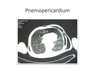 Pnemopericardium
 