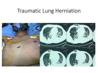 Traumatic Lung Herniation
 
