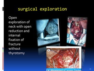 surgical explorationOpen exploration of neck with open reduction and internal fixation of fracture without thyrotomyDr. Naim Manhas20