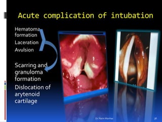  Acute complication of intubationHematoma formationLaceration AvulsionScarring and granuloma formationDislocation of arytenoid cartilageDr. Naim Manhas36