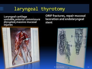    laryngeal thyrotomy<br />ORIF fractures, repair mucosal laceration and endolaryngeal stent<br />Laryngeal cartilage uns...