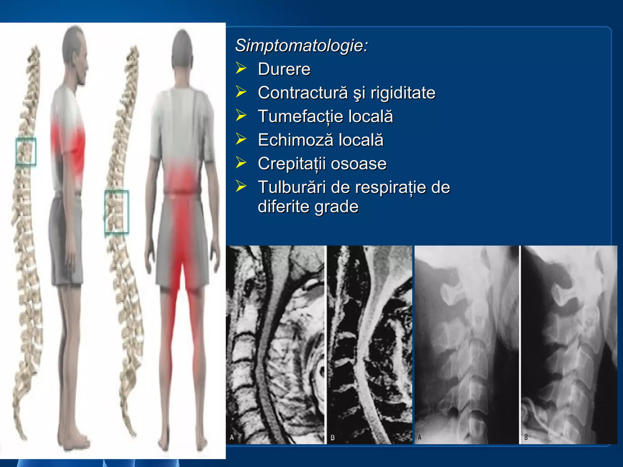 Traumat.vertebro medulare | PPT