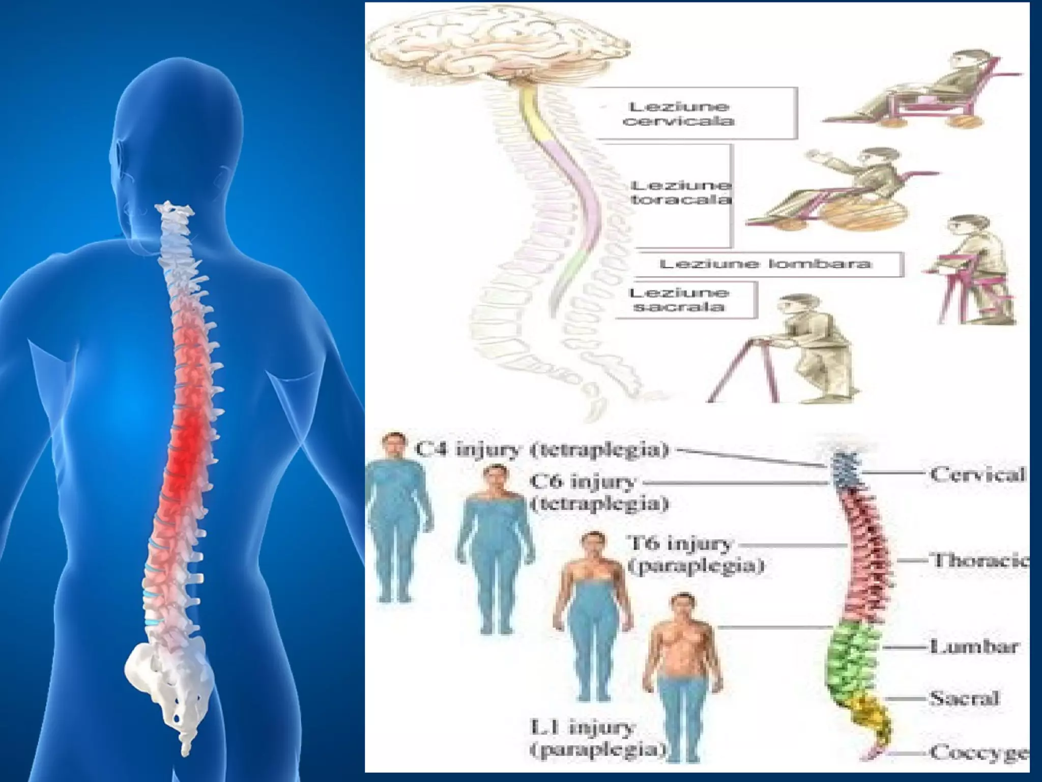 Vertebrogram Traumat.vertebro medulare | PPT