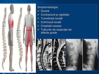 Simptomatologie:Simptomatologie:
 DurereDurere
 Contractură şi rigiditateContractură şi rigiditate
 Tumefacţie localăTumefacţie locală
 Echimoză localăEchimoză locală
 Crepitaţii osoaseCrepitaţii osoase
 Tulburări de respiraţie de Tulburări de respiraţie de 
diferite gradediferite grade
 