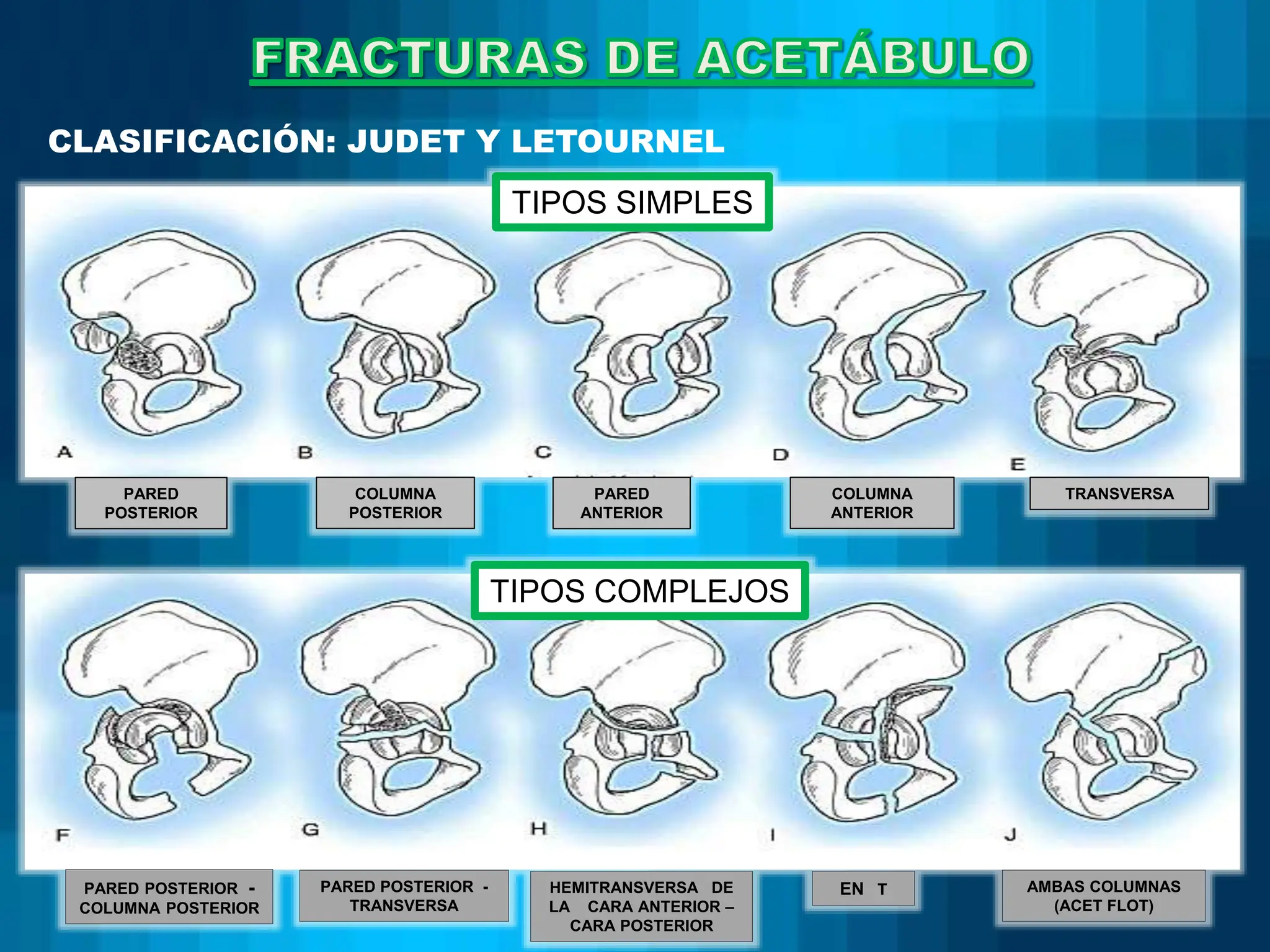 Judet Letournel Classification TRAUMATo fractura de caderannnnnnnnn.pptx